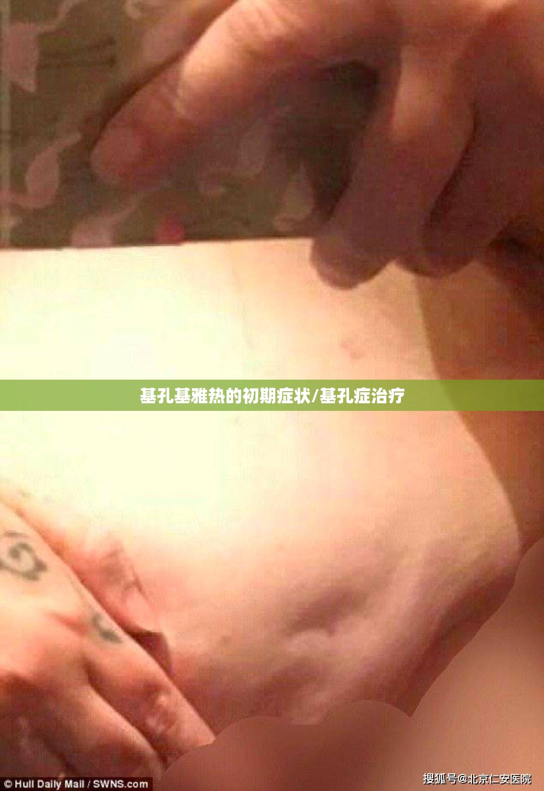 基孔基雅热的初期症状/基孔症治疗